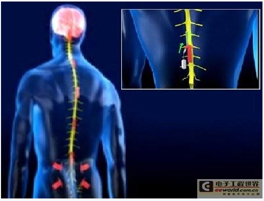 澳科学家发明植入式智能芯片 可缓解慢性疼痛